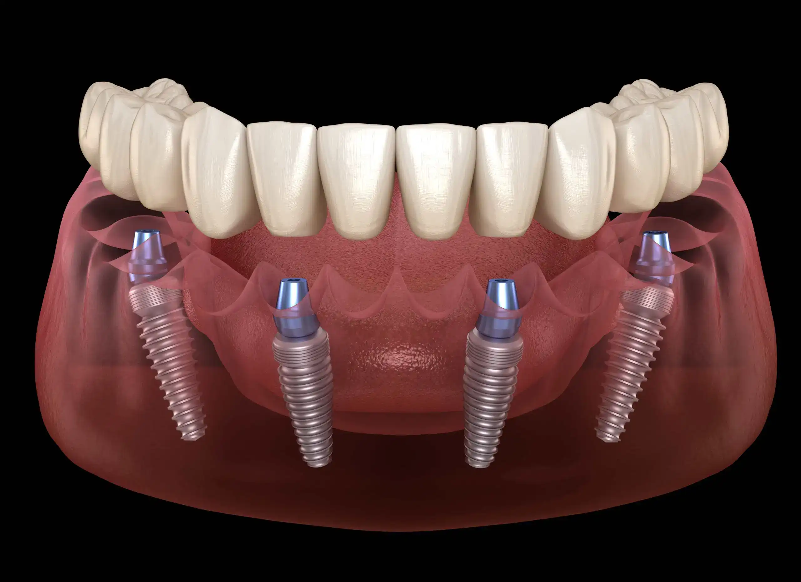 all on dental implants scaled