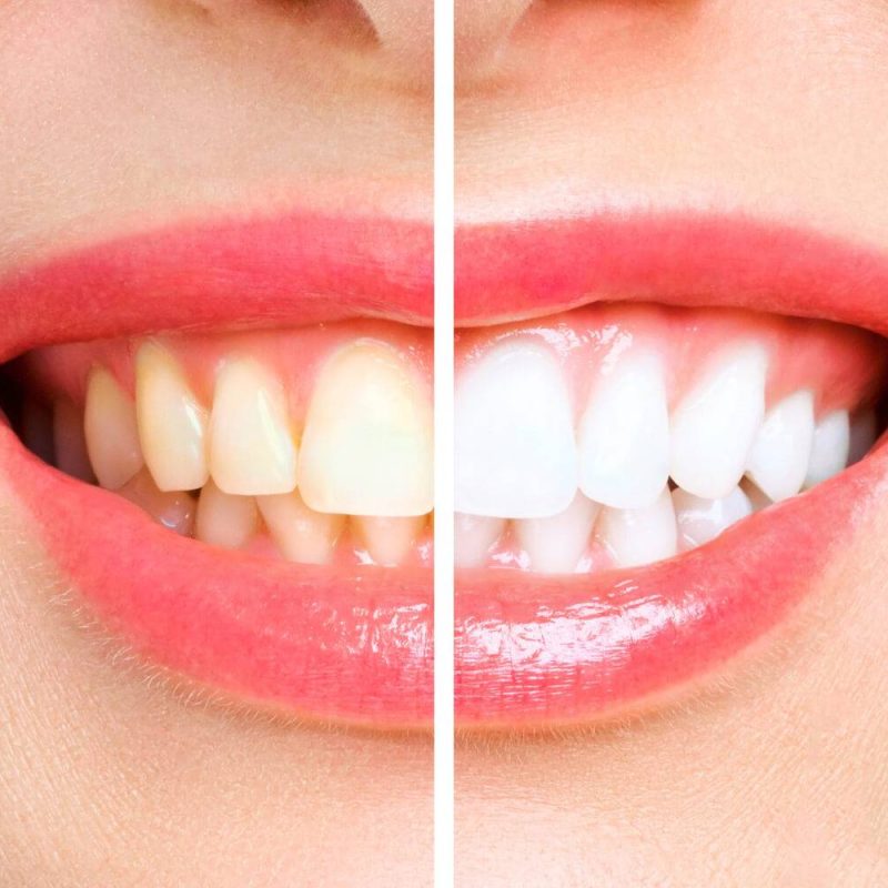 woman teeth before after whitening
